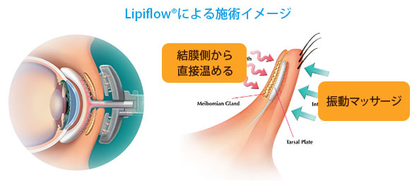 LipiFlowによる施術イメージ